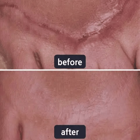 🔥Limited-time 60% sale--LUMIVO Scar Repair Cream — Smooth, Clear, Confident Skin