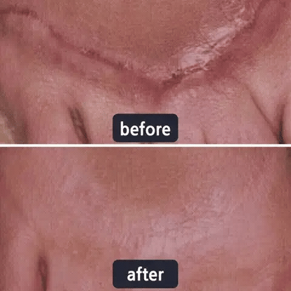 🔥Limited-time 60% sale--LUMIVO Scar Repair Cream — Smooth, Clear, Confident Skin