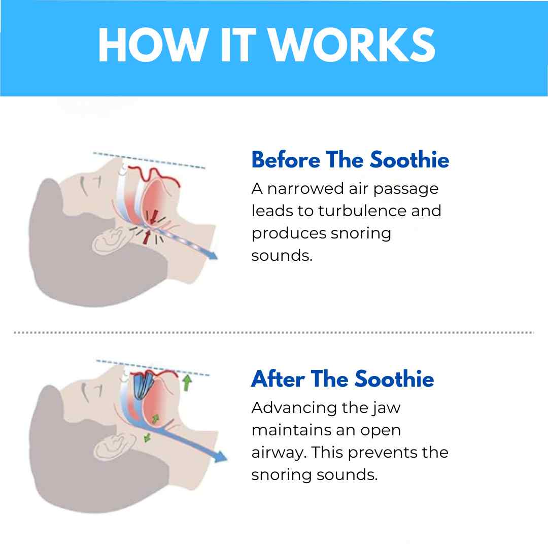 Pryхo™ Professional intelligent anti-snoring device