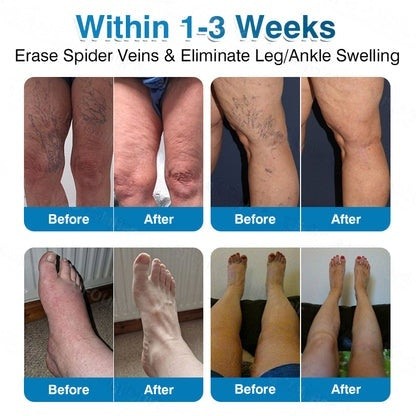 🇦🇺👨‍⚕️✅LUMIVO™ VeinRepair Microneedle Patch Roll⚡Instant Relief, Long-Term Results