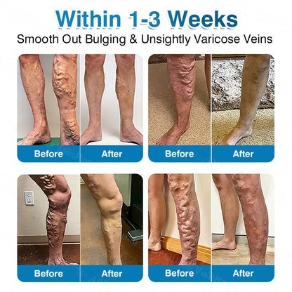 🇦🇺👨‍⚕️✅LUMIVO™ VeinRepair Microneedle Patch Roll⚡Instant Relief, Long-Term Results