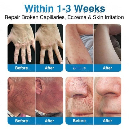 🇦🇺👨‍⚕️✅LUMIVO™ VeinRepair Microneedle Patch Roll⚡Instant Relief, Long-Term Results