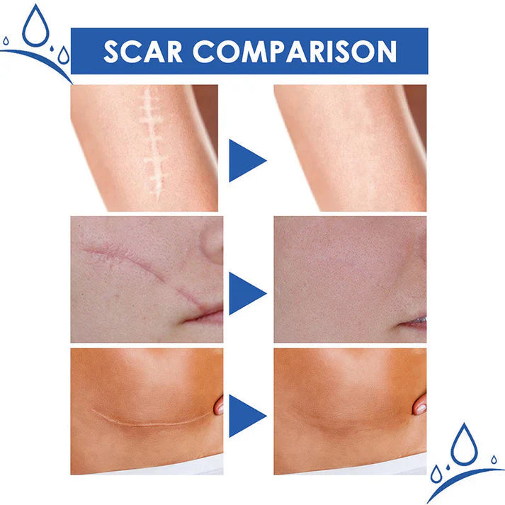 🔥Limited-time 60% sale--LUMIVO Scar Repair Cream — Smooth, Clear, Confident Skin