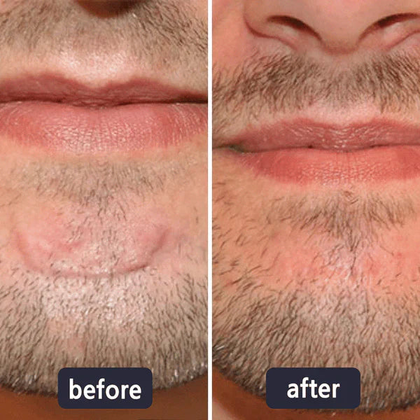 🔥Limited-time 60% sale--LUMIVO Scar Repair Cream — Smooth, Clear, Confident Skin