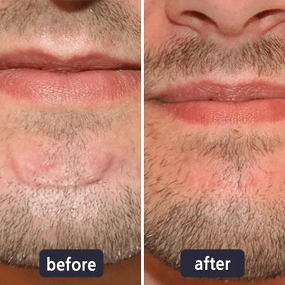 🔥Limited-time 60% sale--LUMIVO Scar Repair Cream — Smooth, Clear, Confident Skin